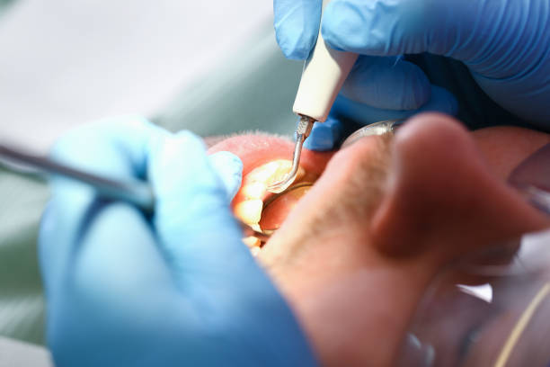 Best Emergency Tooth Extraction in Eglin Af, FL